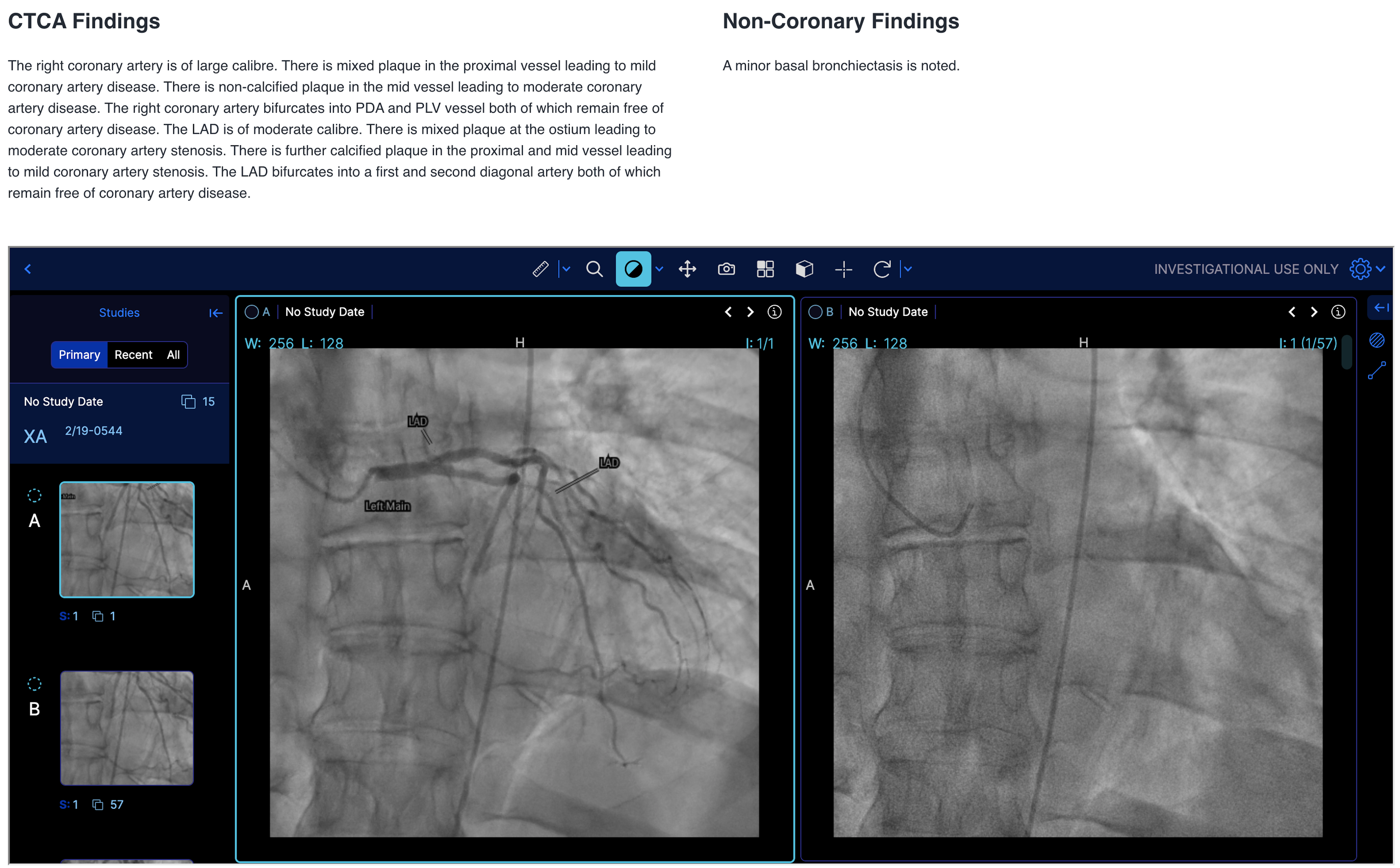 The Cardiac CT Course Review page. The CTCA Findings and Non-Coronary Findings are shown as text, along with a DICOM viewer showing a correlated angiogram for the patient.